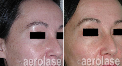 Before-and-after of a face with uneven skin tone. Aerolase laser treatment appears to reduce sunspots and hyperpigmentation.