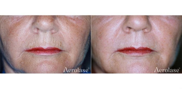 Comparison of a person's face before and after skin treatment, showing reduced wrinkles around the mouth.