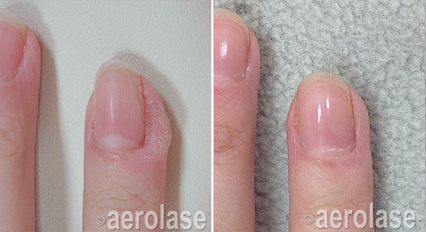 Before-and-after of a fingernail, showing damaged nail improving after a treatment.