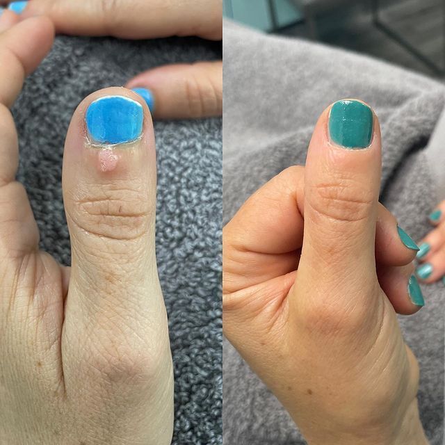 Two side-by-side photos of a thumb with a growth on it. The growth is gone in the second photo, after treatment.