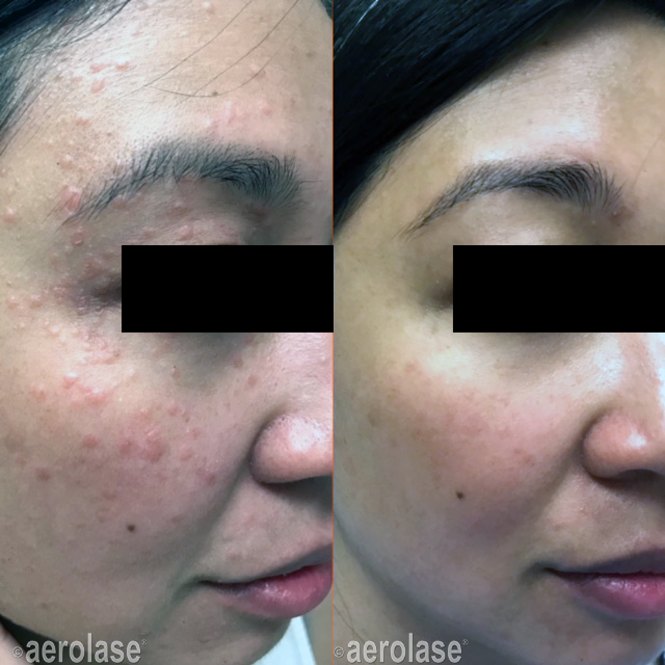 Before and after photos of skin, showing reduced acne after aerolase treatment.