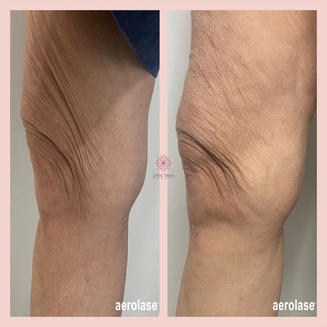 Before and after photos of a knee and thigh area with reduced wrinkles after Aerolase treatment.