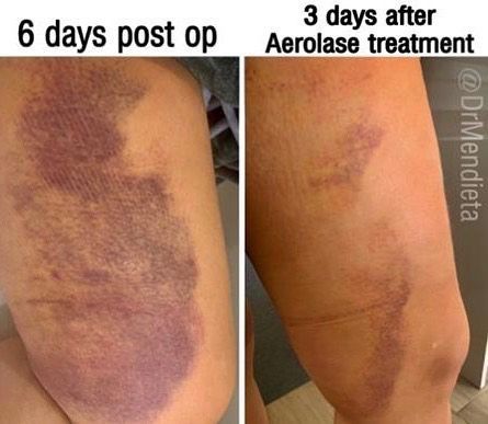 Comparison of a leg with extensive bruising 6 days post-op and 3 days after Aerolase treatment, showing reduction in discoloration.