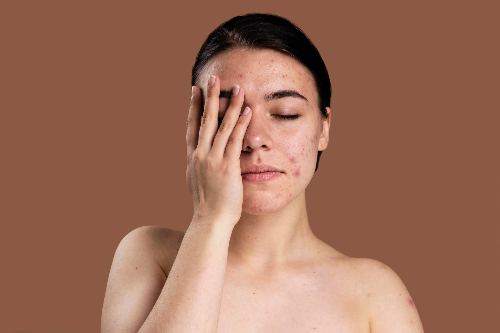 Woman with skin blemishes covering her eye with hand, against brown background.