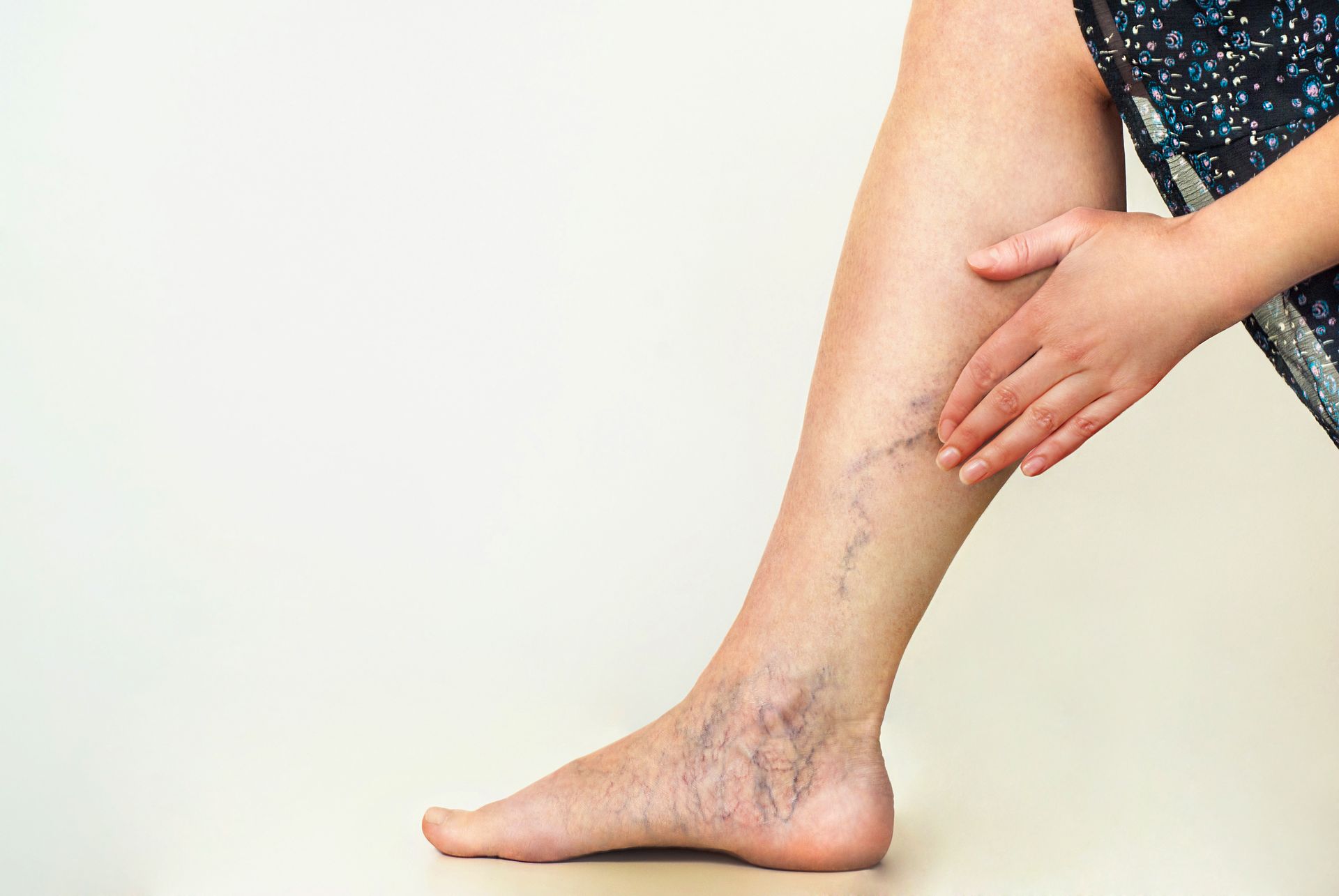 Leg with visible varicose veins; hand touching leg.
