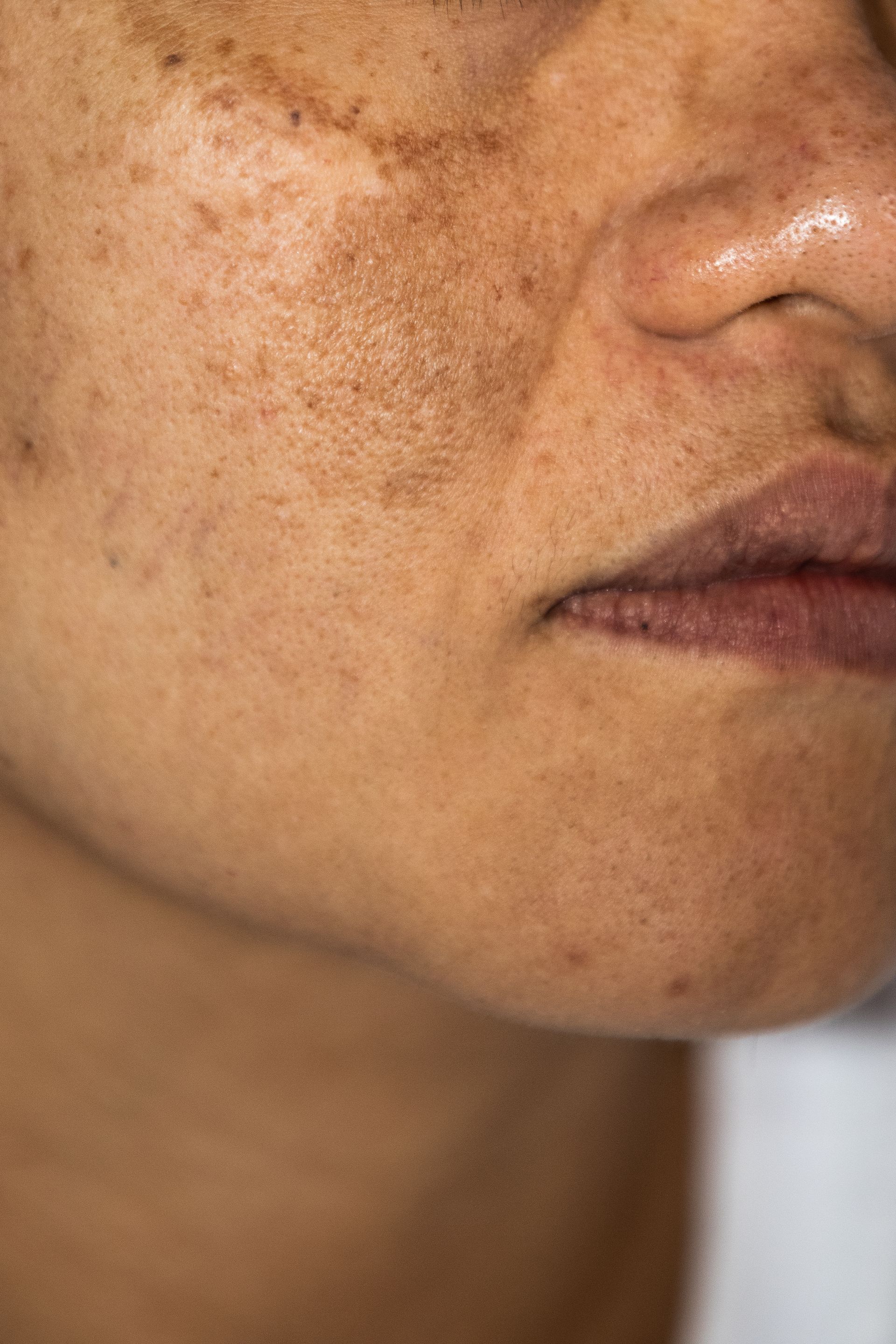 Close-up of a person's face showing skin discoloration with freckles and darker patches.