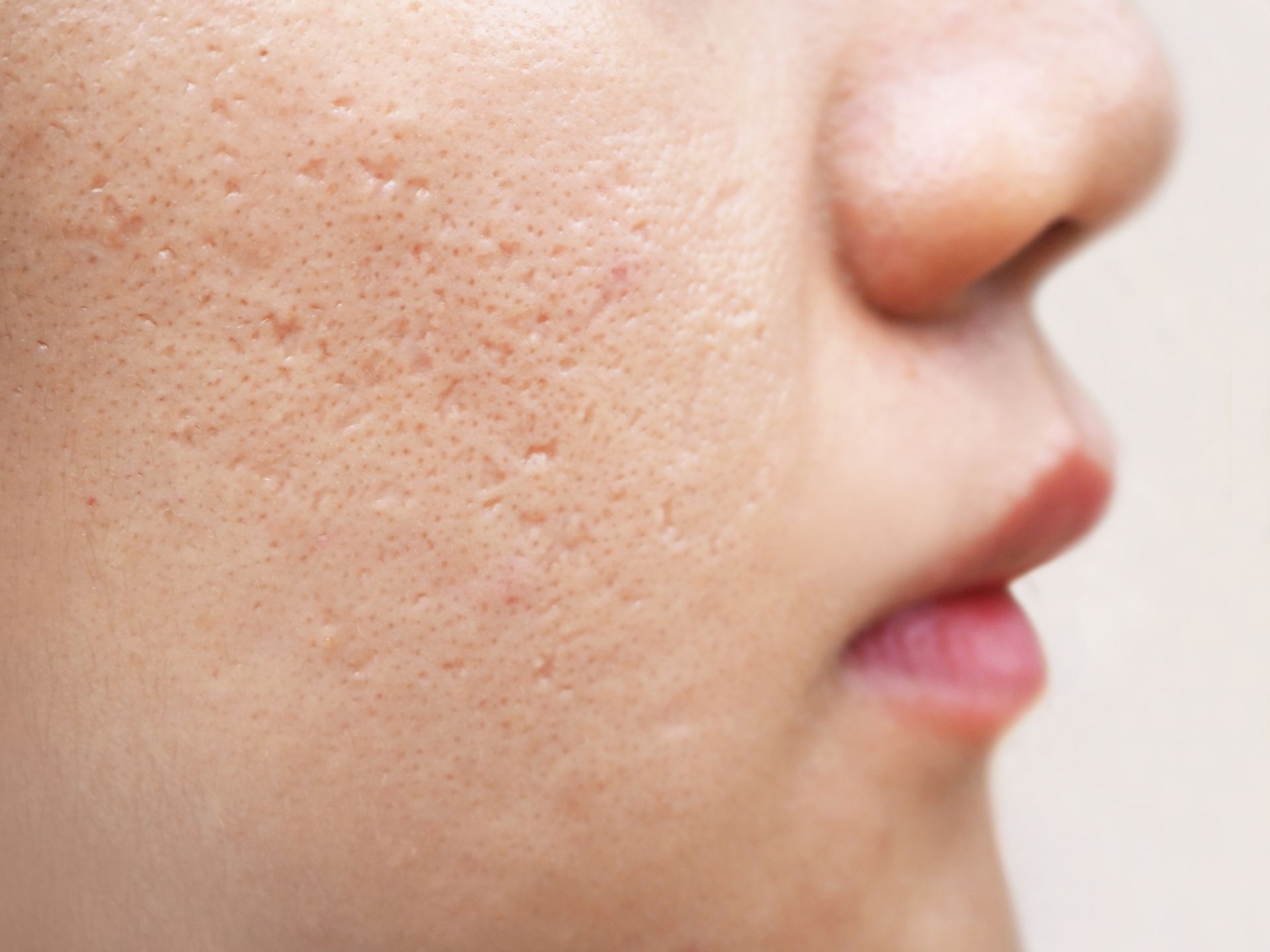 Close-up of a person's face showing uneven skin texture with visible acne scars.