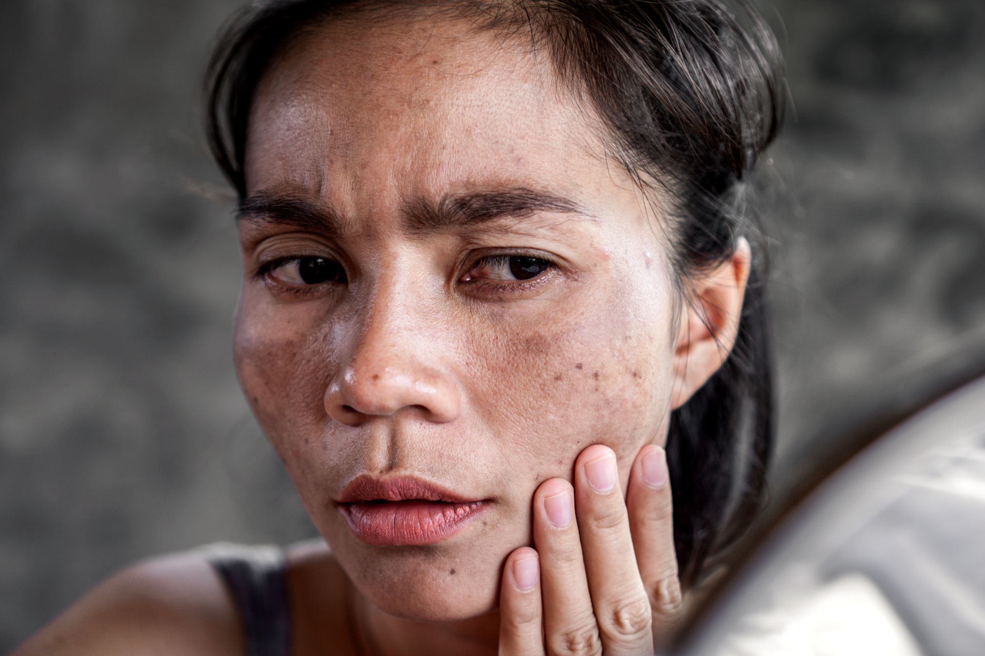 Woman with skin blemishes looks at herself in a mirror, touching her cheek.