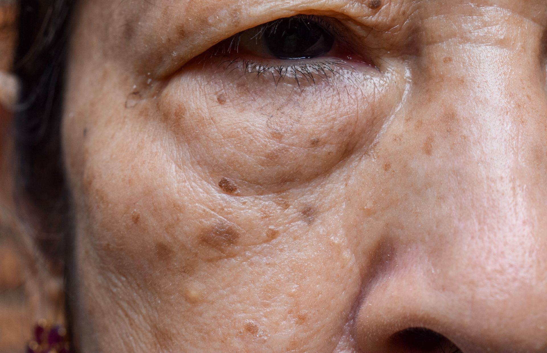 Close-up of a person's eye, showing puffy eyelids, dark circles, and sunspots on the skin.