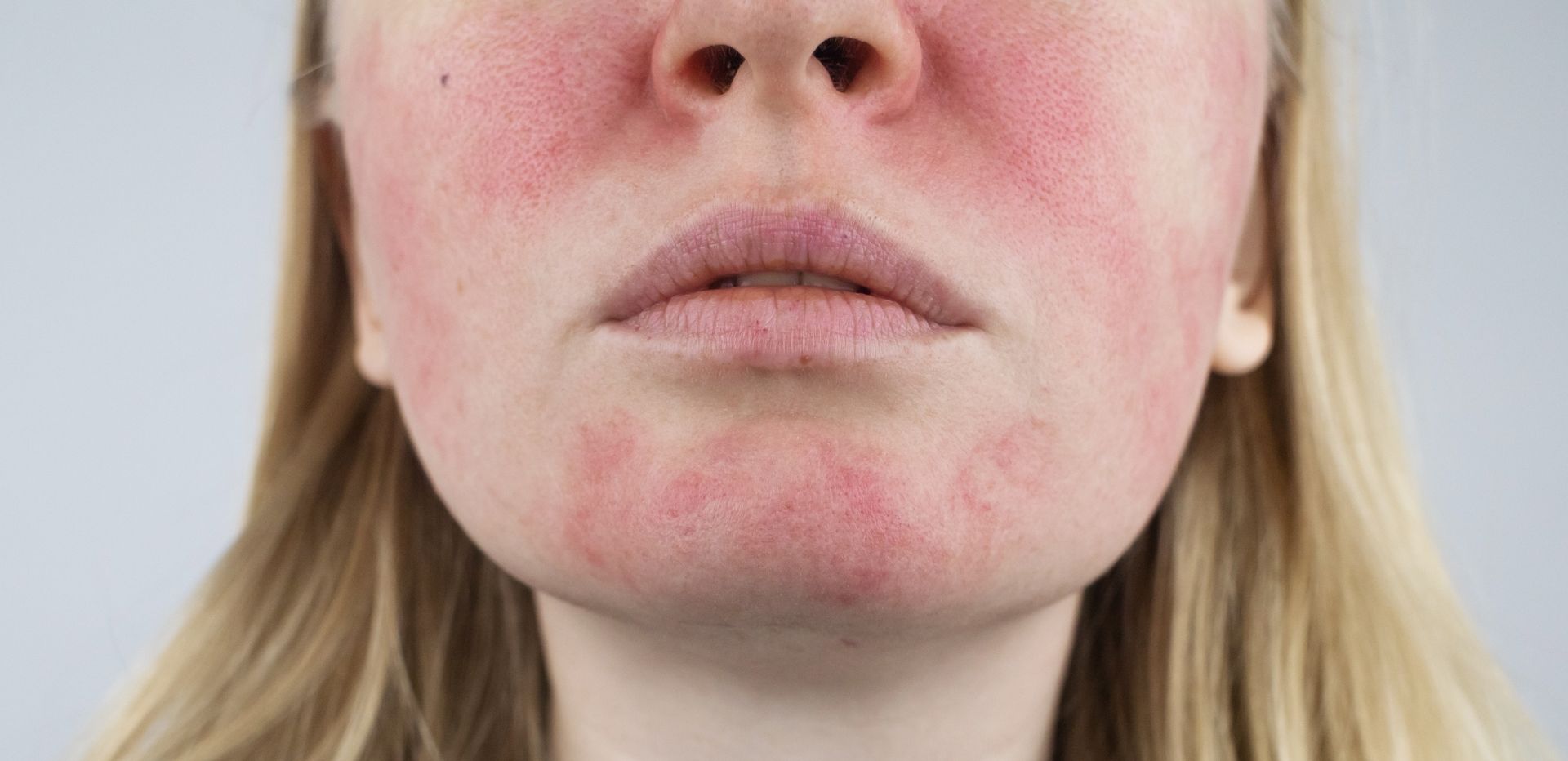 Person with visible redness and inflammation on face and chin.