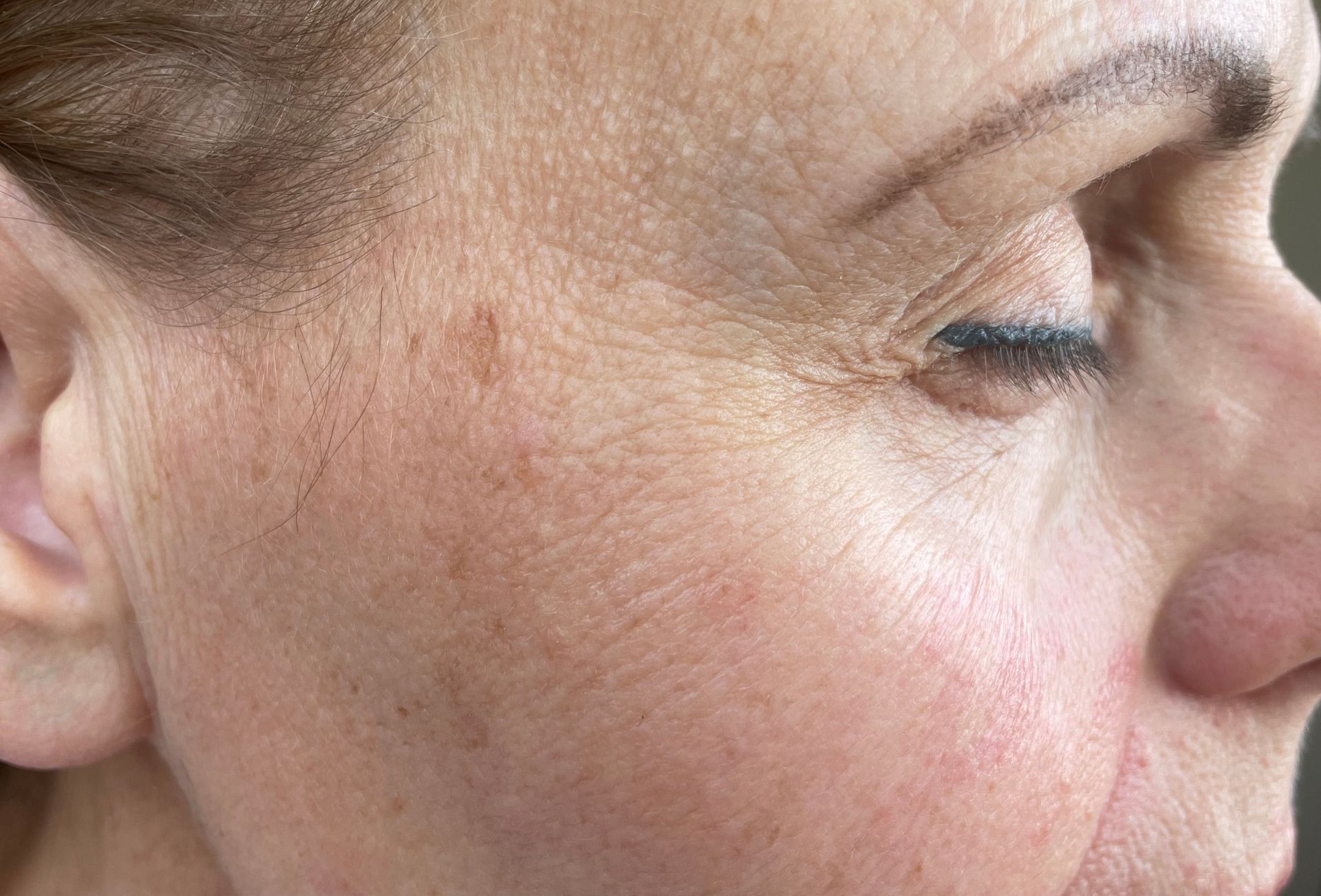 Close-up of a person's face showing skin texture, brown spots, and closed eye.