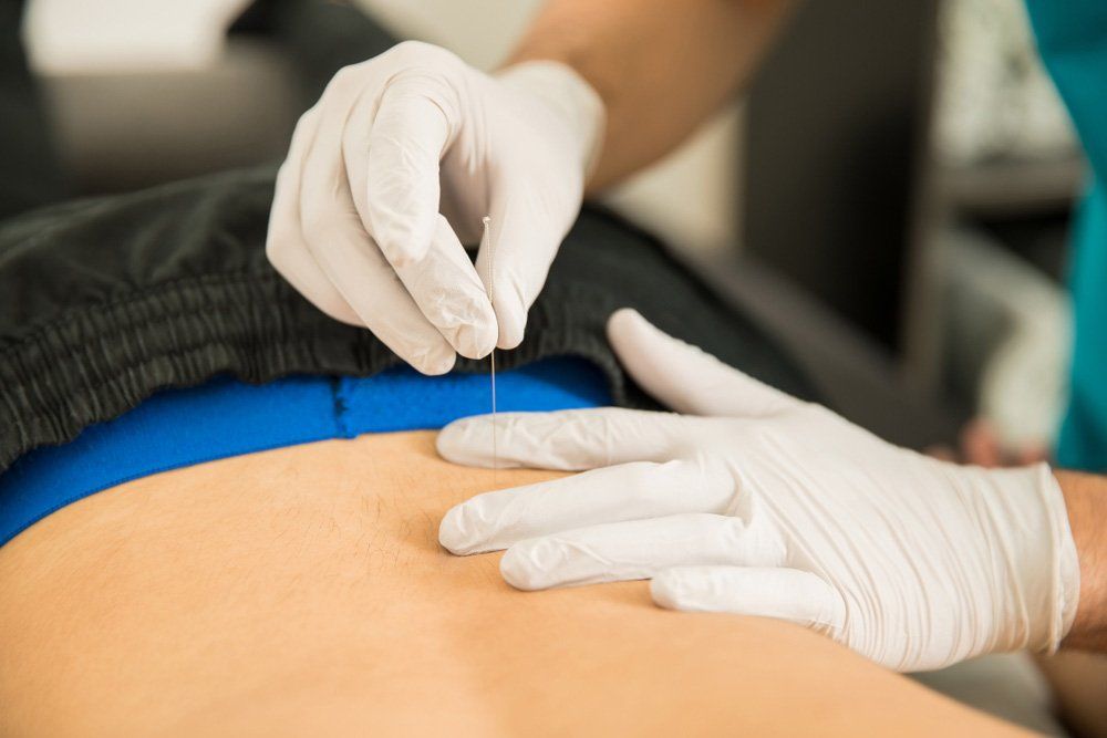 Male Physiotherapist Doing Dry Puncture on the Back of Patient — PhysioCare Townsville In Thuringowa Central, QLD