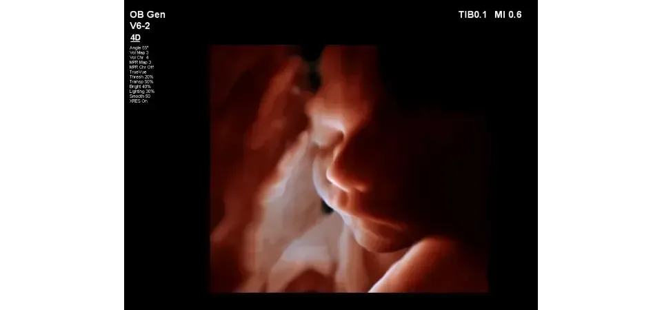 in utero baby face on Philips EPIQ 7 
ultrasound screen