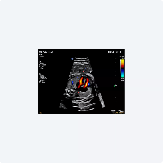 ultrasound image of a baby