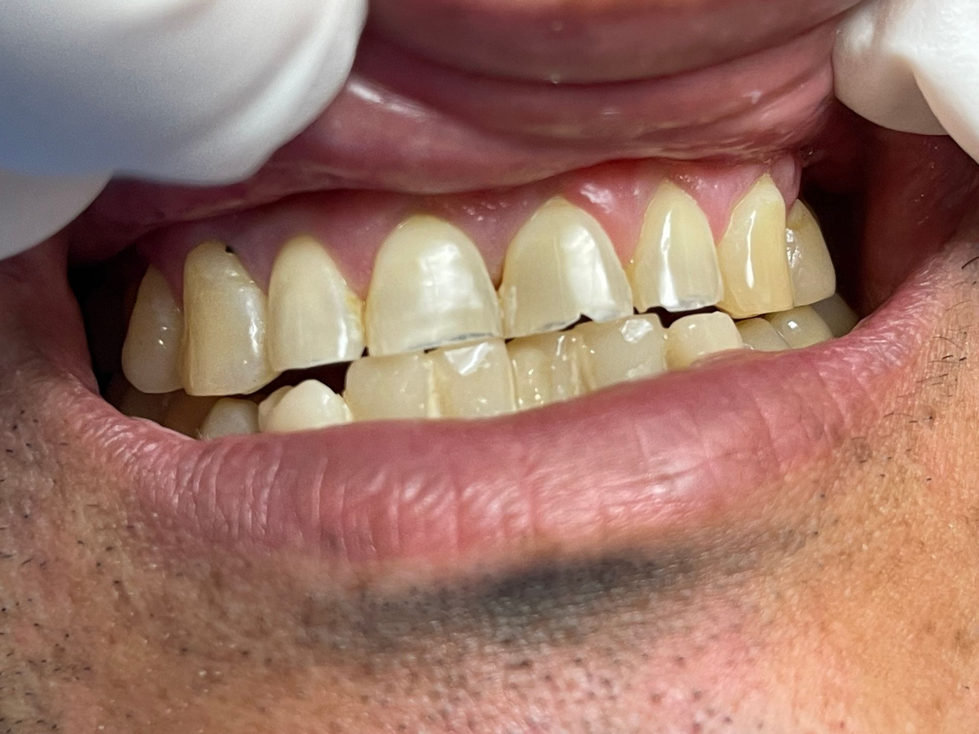 A close up of a man 's teeth with gloves on.