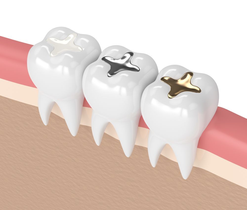 Three teeth with different types of fillings in them.