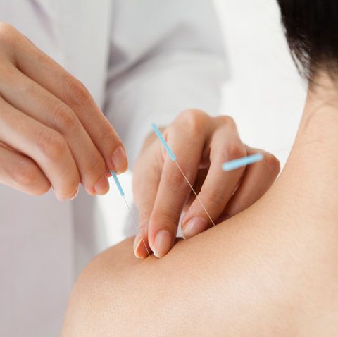 A person is getting acupuncture on their back
