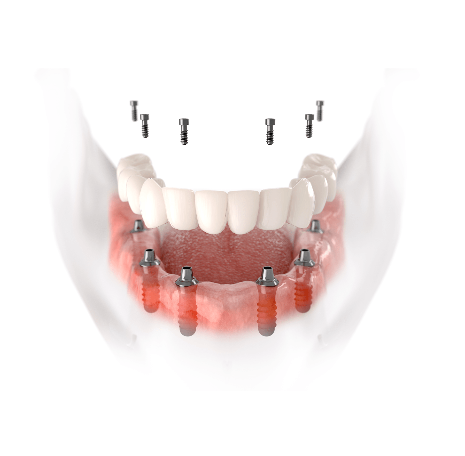 A model of a denture with a lot of screws on it