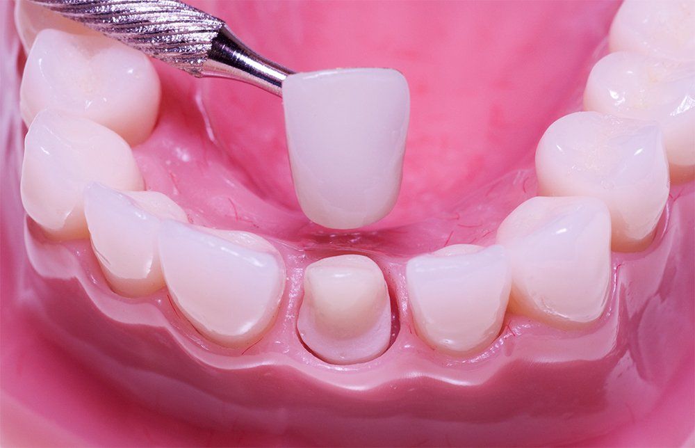 Dental Crowns Flushing