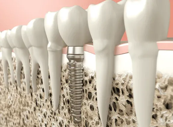 3D Model Of Dental Implant — Runcorn, QLD — Runcorn Dental