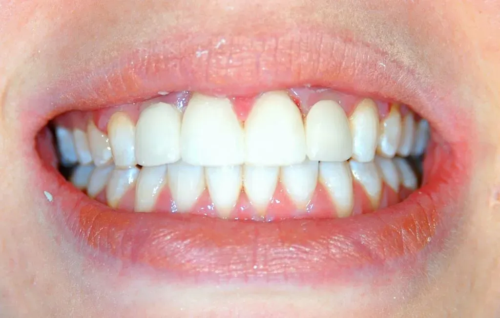 Complete Teeth — Runcorn, QLD — Runcorn Dental
