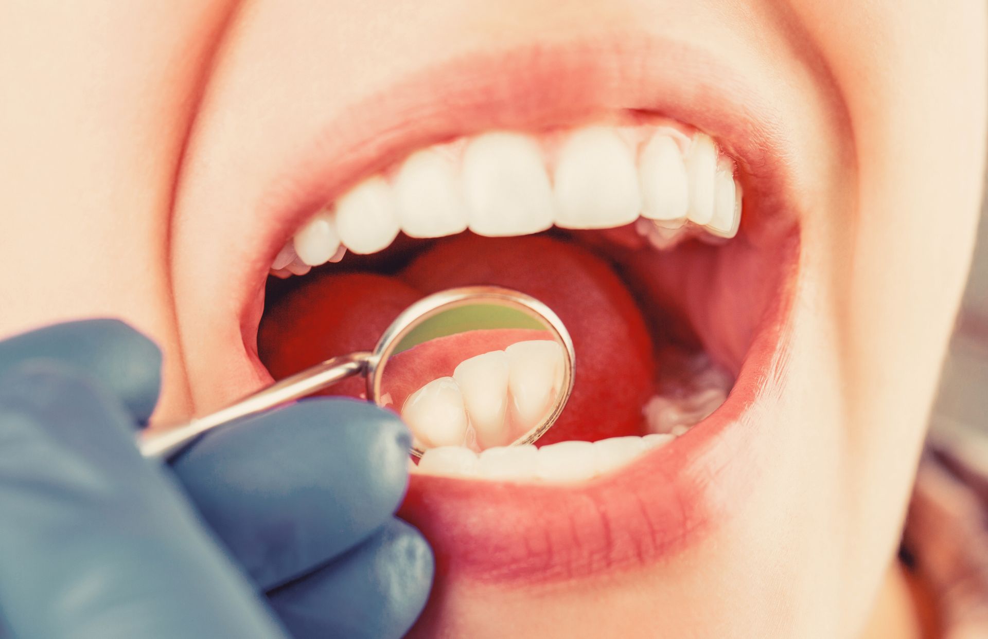 Close-up of a person's open mouth with a dentist holding a mirror to inspect the teeth.