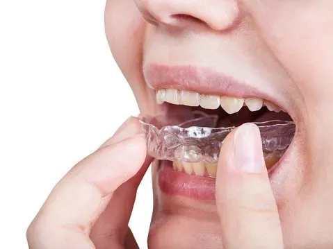 Putting A Night Guard — Runcorn, QLD — Runcorn Dental Putting A Night Guard — Runcorn, QLD — Runcorn Dental