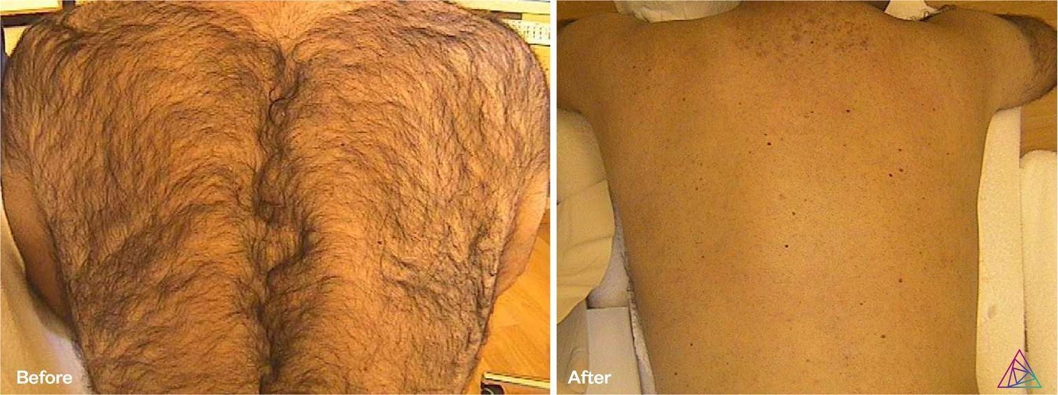 Back Laser Hair Removal | Springfield, MO