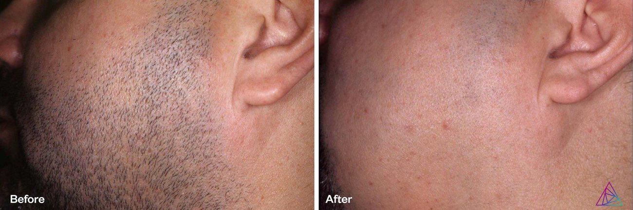 Before and after comparison of a person's skin.