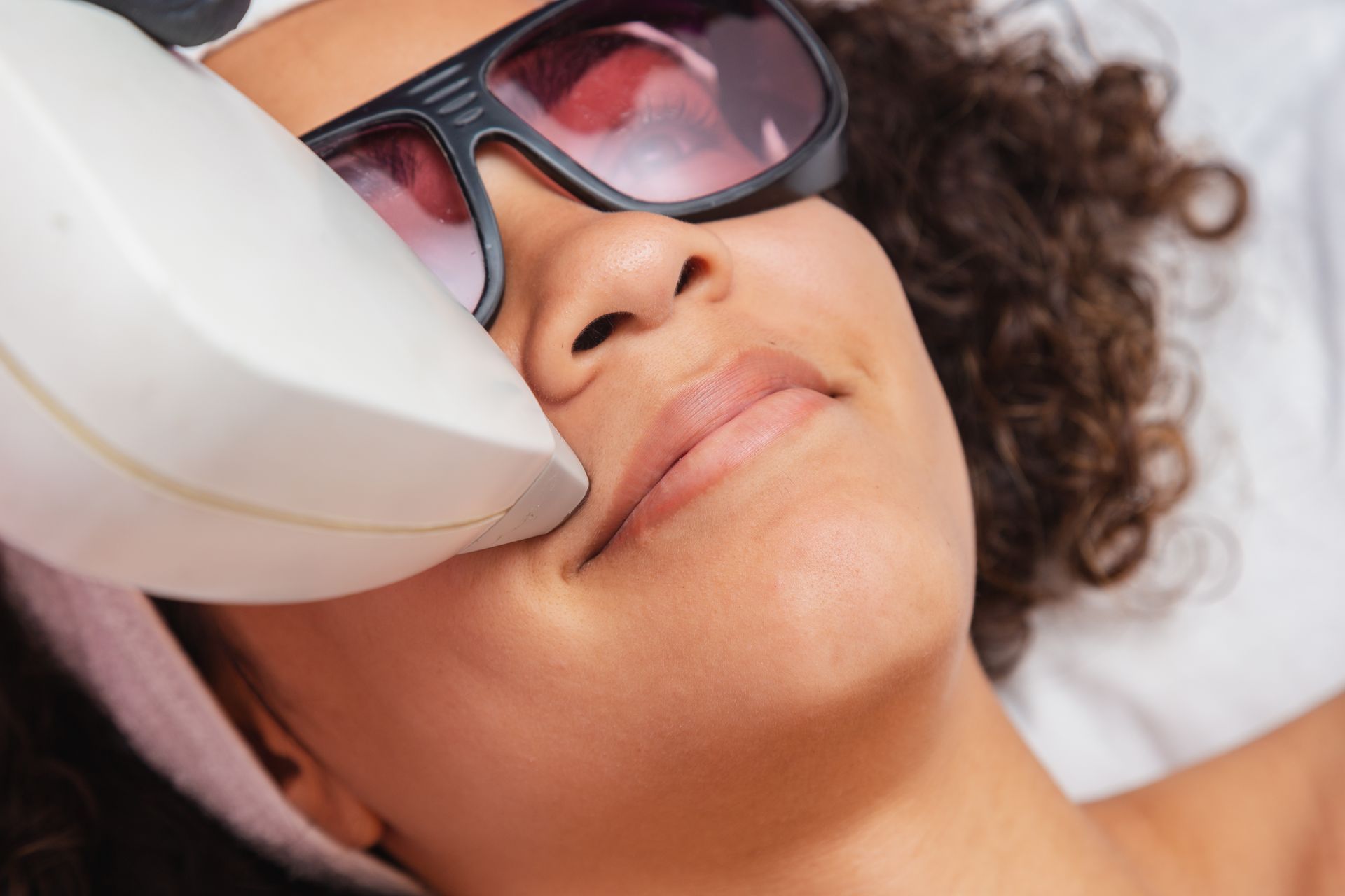 Woman undergoing laser hair removal on her upper lip.