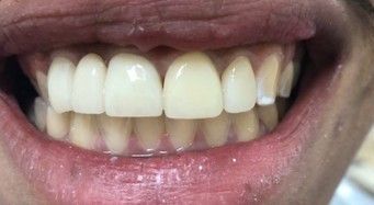 A close up of a person 's mouth with white teeth.