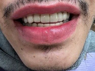 A close up of a person 's mouth with a lot of teeth.