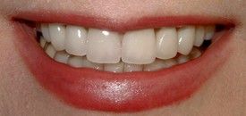 A close up of a woman 's smile with white teeth and red lips.