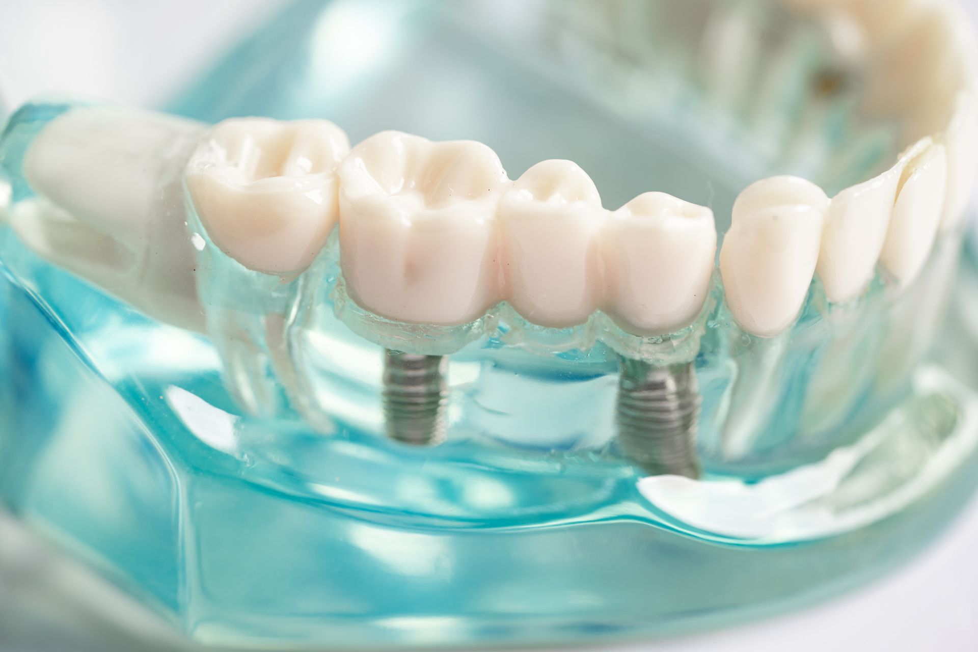 A close up of a model of teeth with dental implants.