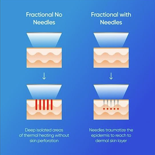 A diagram showing the difference between fractional no needles and fractional with needles