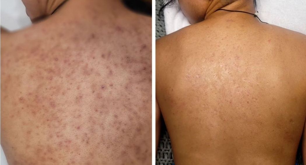 Acne Boot Camp