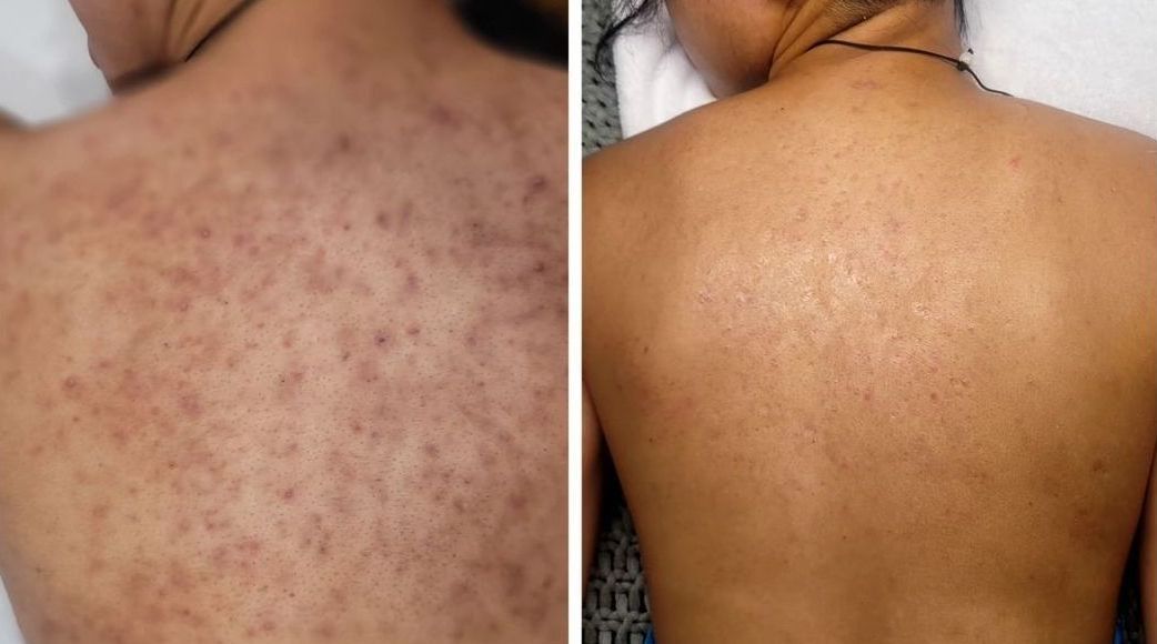 Acne Boot Camp