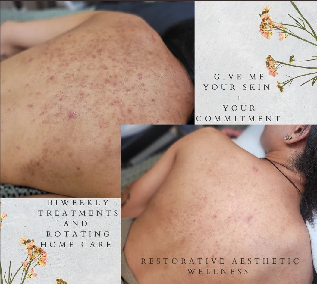 A woman with acne on her back is laying on a bed