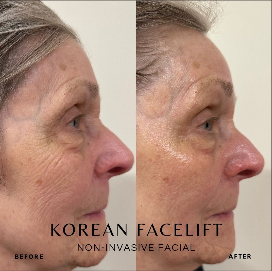 Korean Facelift before and after