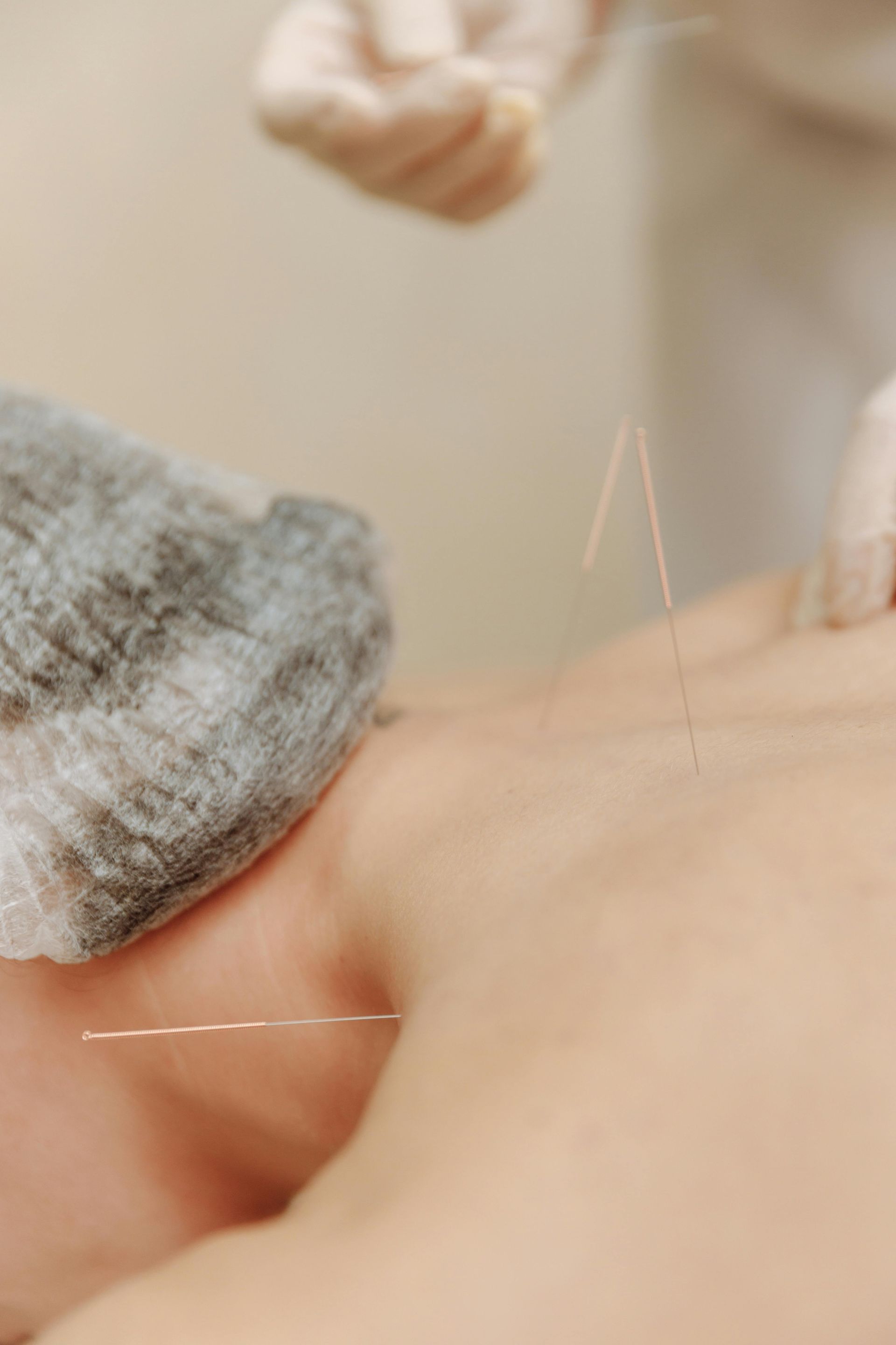 Akupunkturnadeln im Nacken einer Patientin