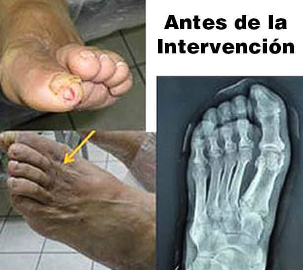 INSTITUTO DE ANGIOLOGIA Y CIRUGIA VASCULAR DEL NORESTE - PIE DIABÉTICO INSTITUTO DE ANGIOLOGIA Y CIRUGIA VASCULAR DEL NORESTE - PIE DIABÉTICO
