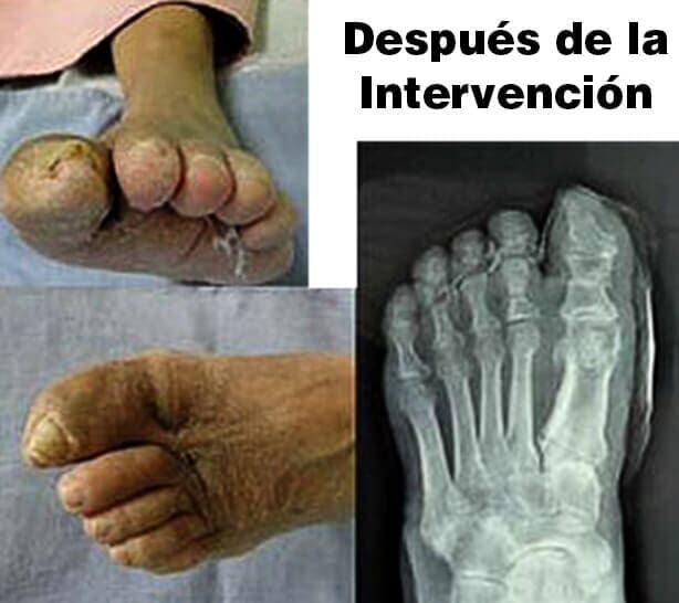 INSTITUTO DE ANGIOLOGIA Y CIRUGIA VASCULAR DEL NORESTE - HERIDAS CRÓNICAS INSTITUTO DE ANGIOLOGIA Y CIRUGIA VASCULAR DEL NORESTE - HERIDAS CRÓNICAS