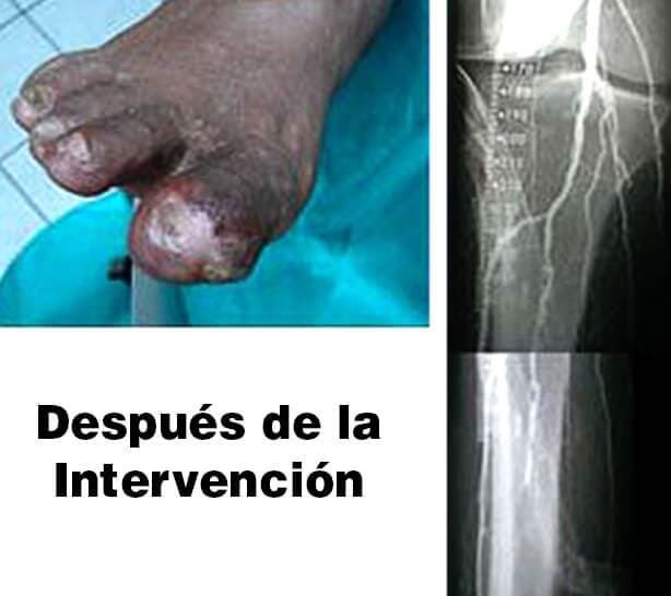 INSTITUTO DE ANGIOLOGIA Y CIRUGIA VASCULAR DEL NORESTE - DEFORMIDADES EN PIES INSTITUTO DE ANGIOLOGIA Y CIRUGIA VASCULAR DEL NORESTE - DEFORMIDADES EN PIES