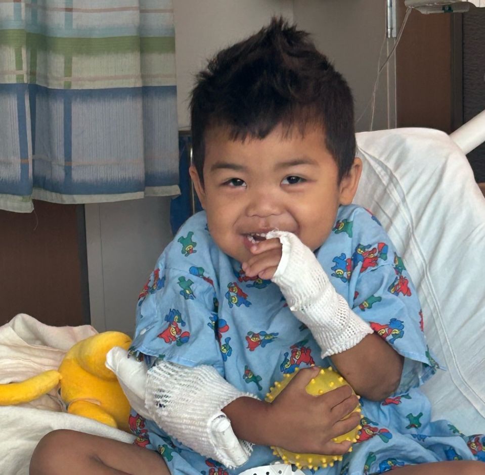 A child in a hospital gown with bandages on both hands smiles while holding a yellow sensory ball in a hospital bed.