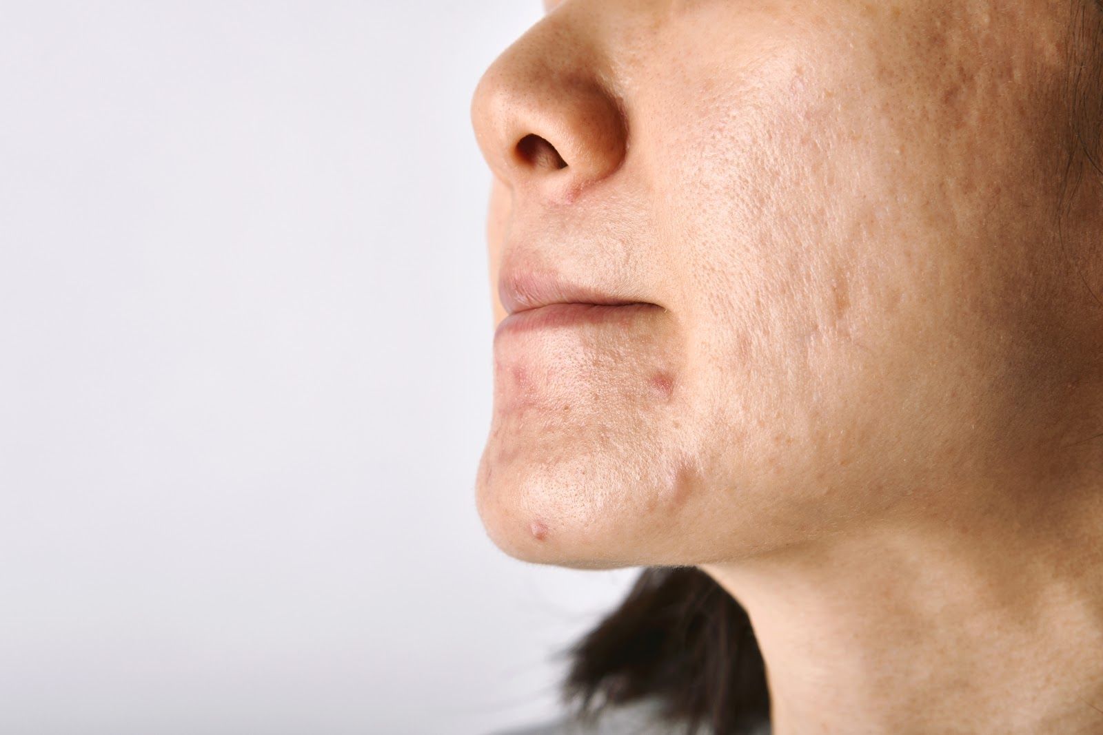 Close-up side view of a person’s lower face and chin with visible acne on the skin