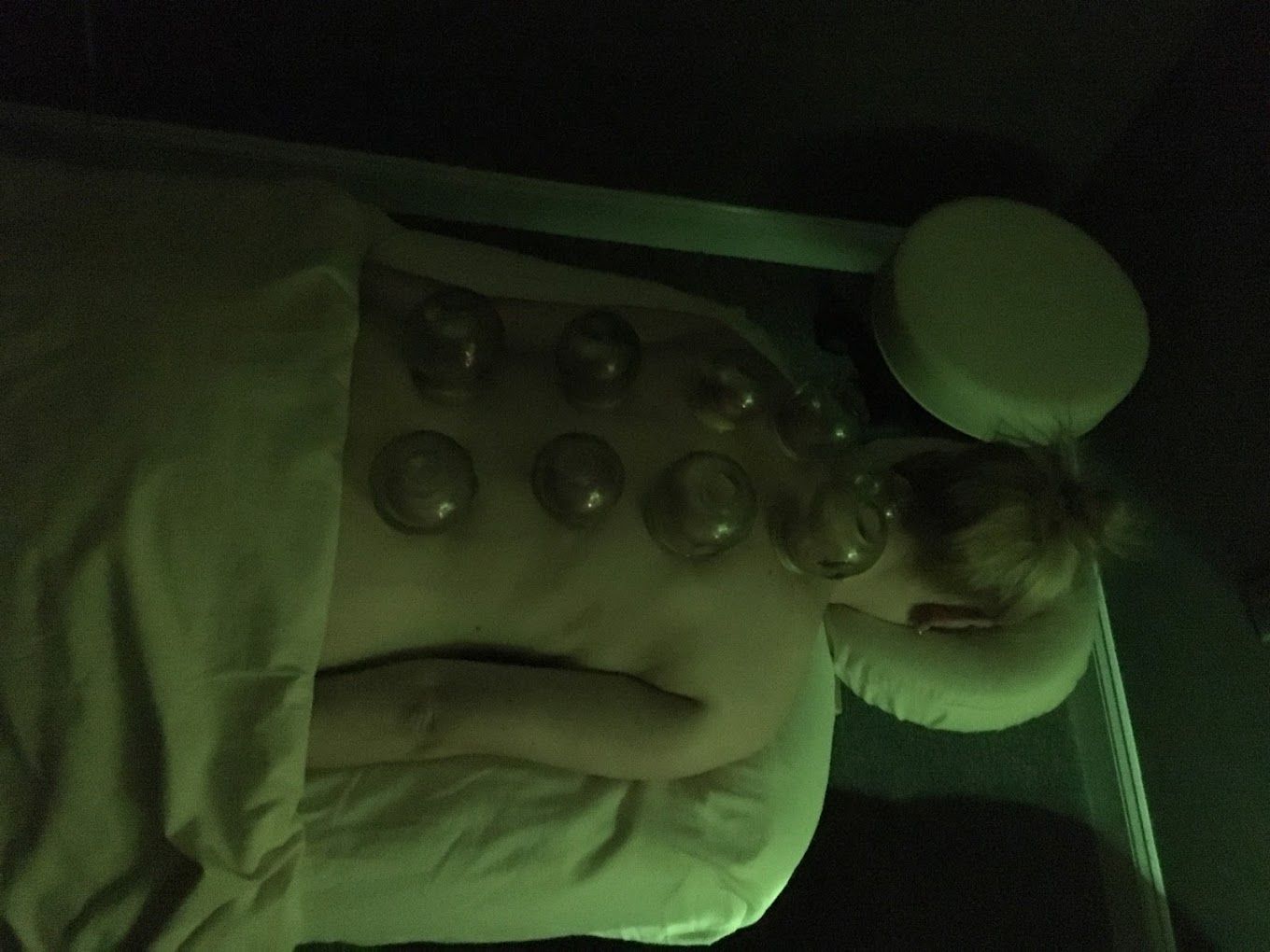 A woman is laying on a bed with cups on her back