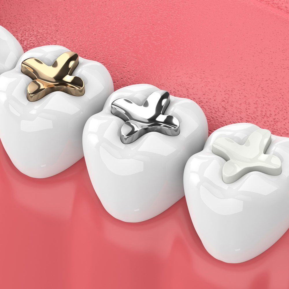 Dental Inlay — Sarasota, FL — Sterling Dental