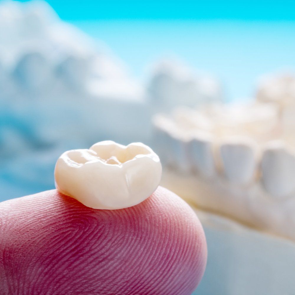 Dental Crown — Sarasota, FL — Sterling Dental Dental Crown — Sarasota, FL — Sterling Dental