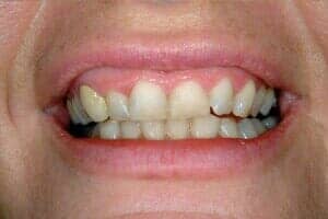 Teeth Before Whitening — Sarasota, FL — Sterling Dental