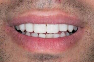 Teeth After The Procedure — Sarasota, FL — Sterling Dental
